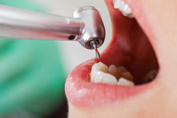 Best Emergency Tooth Extraction in Stuttgt, AR